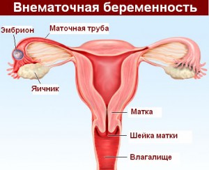 Матка при внематочной беременности