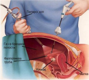 Как делают Лапроскопию